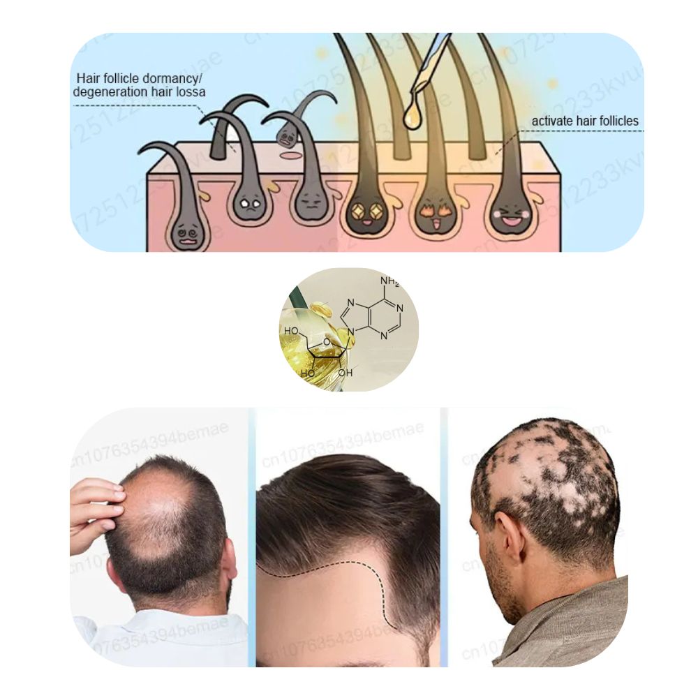 ADENOSINE Hair Growth Serum | Fast Treatment of Hair Loss in Hereditary and Seborrhoeic Alopecia 