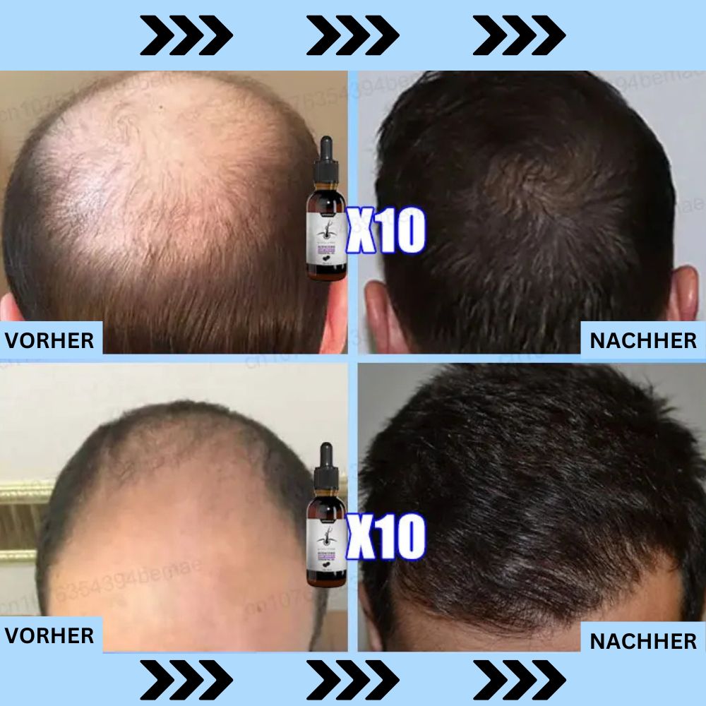 ADENOSINE Hair Growth Serum | Fast Treatment of Hair Loss in Hereditary and Seborrhoeic Alopecia 